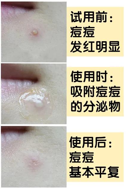 片仔癀痘痘贴解救痘痘,片仔癀祛痘印最有效的方法