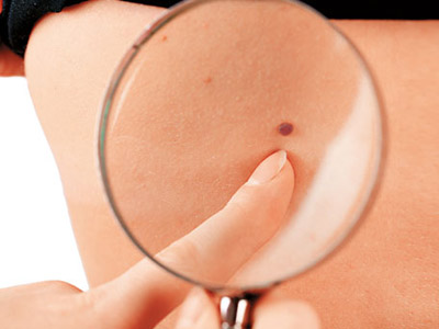 身上的红色痣怎么去掉,身上的痣能随便去掉吗