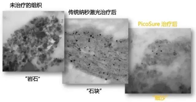 小皮秒效果怎么样,皮秒什么情况下会脱色