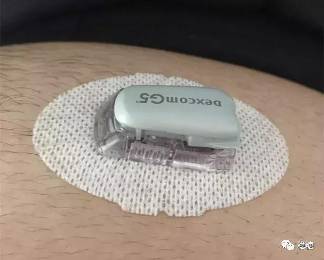 胰岛素泵闭环控糖效果,闭环胰岛素泵是什么意思