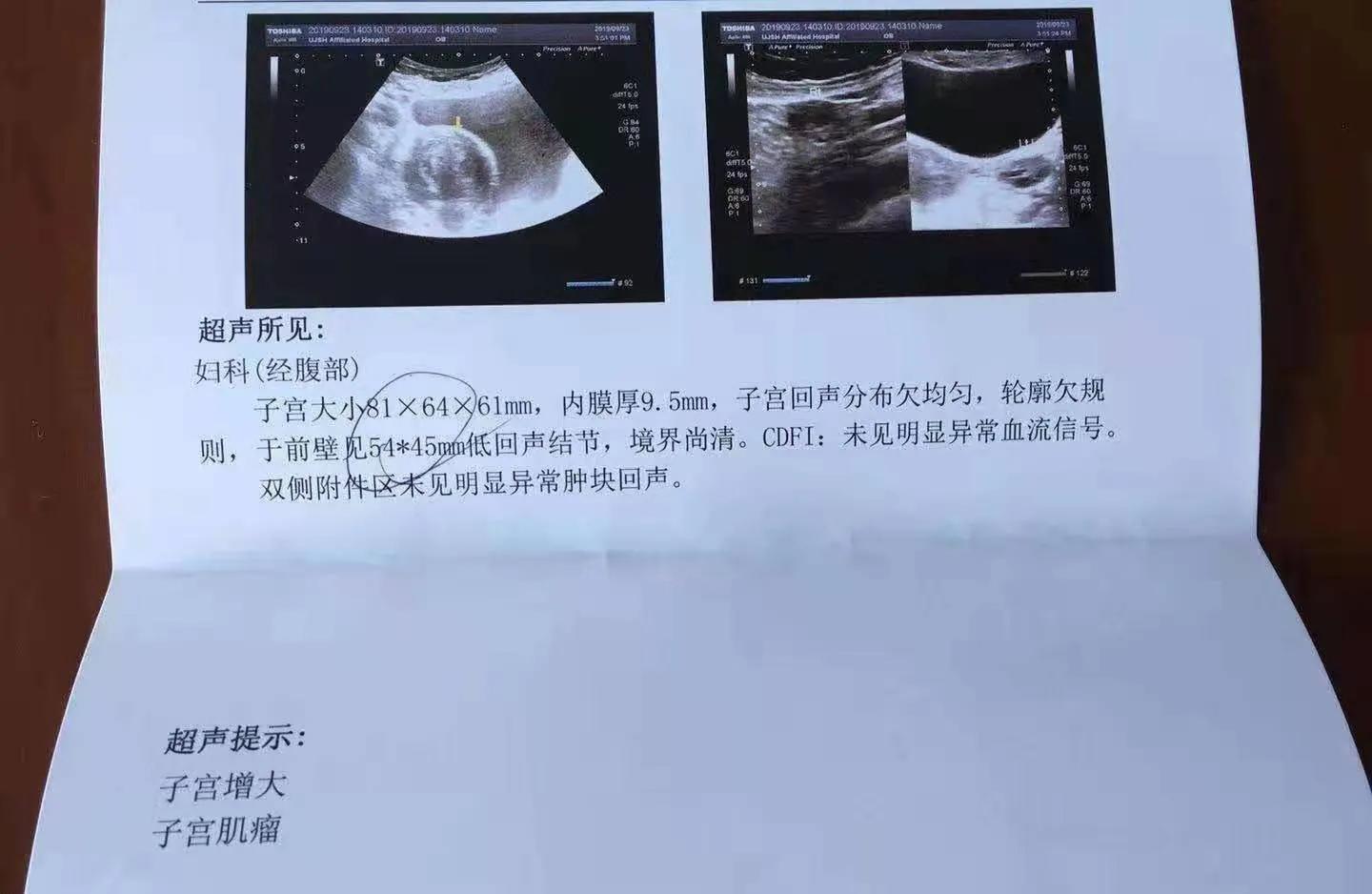 鸡蛋大小的子宫肌瘤能消除吗?