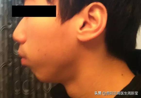 12岁前必须解决的错颌畸形,孩子十二岁牙畸形怎么办