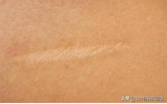 髋关节置换的潘多拉魔盒——术后下肢长短的几种特殊情况