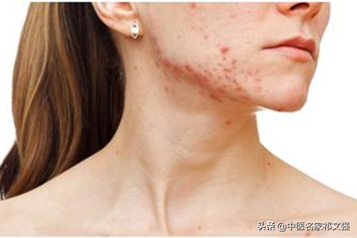 长疮的中医辨证论治,疮疡后期中医治疗法则