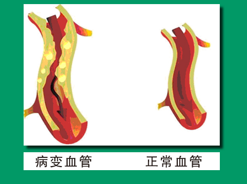 血管狭窄40%是心梗吗,血管狭窄50%症状明显需要支架吗