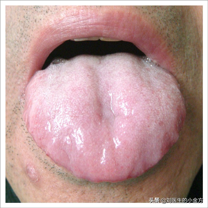 舌象图解大全中医舌诊,最全中医舌诊图谱来了