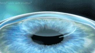 爱尔眼科全飞秒五折,近视手术全飞秒16800元