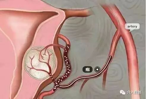 介入治疗腺肌病效果好吗,介入微创治疗子宫腺肌病是什么