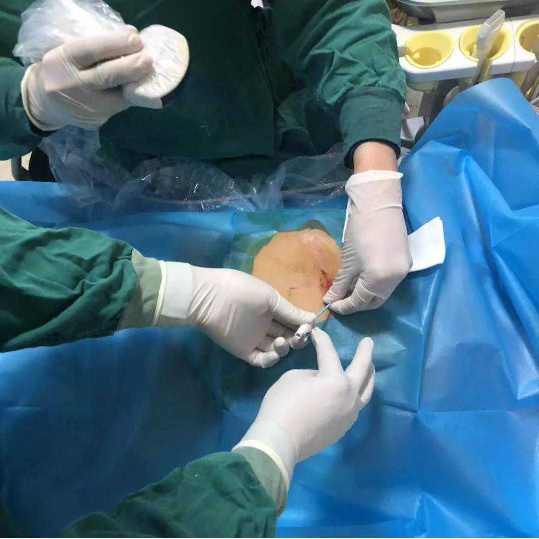 梗阻性黄疸ptcd引流管一般戴多久,梗阻性黄疸的诊疗