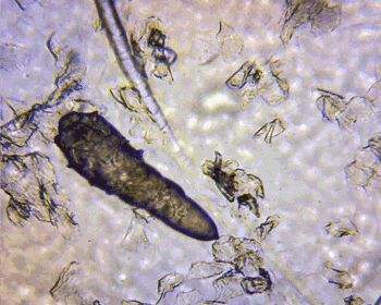 痘痘感染后愈合形成痘坑,痘痘反反复复就是不彻底该怎么办