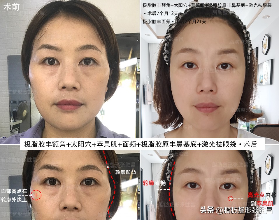 做脂肪填充面部以后变胖了,做脂肪面部填充会变美吗