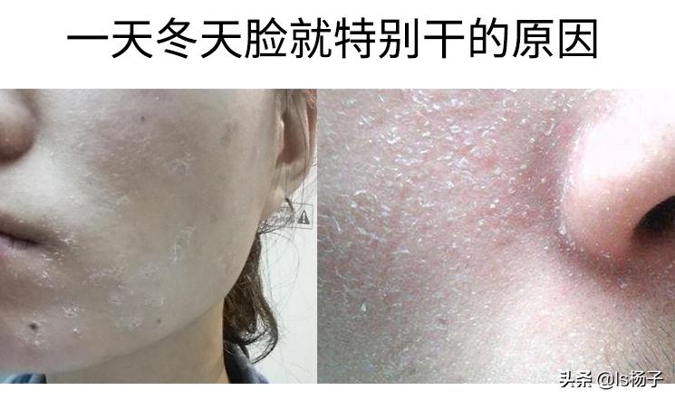 冬天脸干燥用什么补水,冬天脸特别干怎么补水