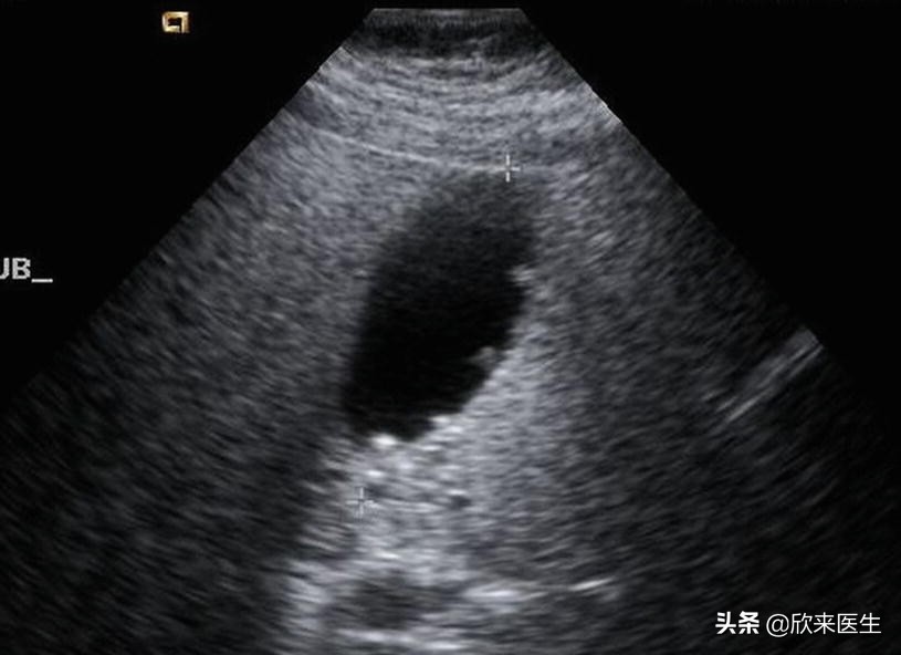 体检查出胆囊息肉是怎么回事,胆囊息肉要紧吗影响公务员体检吗