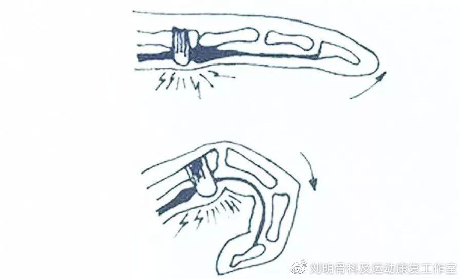 手指痛伸不开是什么原因引起的,手指伸不直一伸就疼有什么药