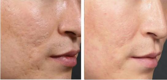 最省钱最有效的医美项目,最值得做的医美项目前三甲