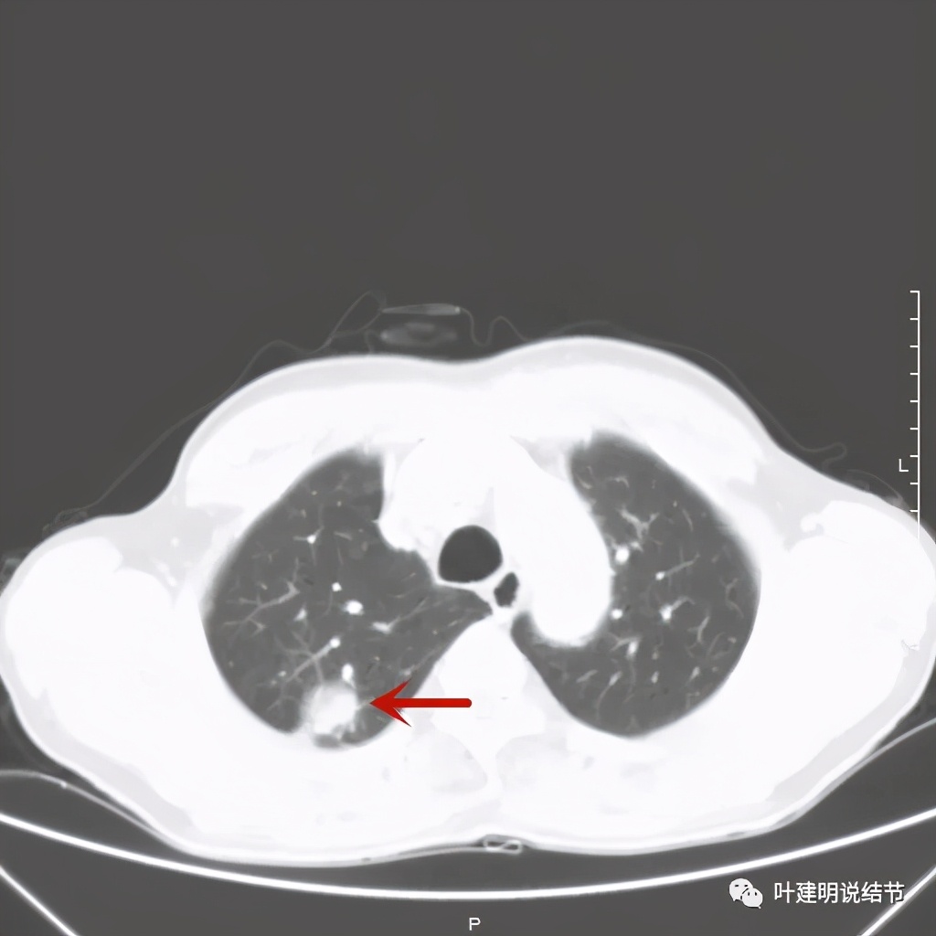 肺占位病理活检无病变,肺部占位穿刺病理说不确定性质