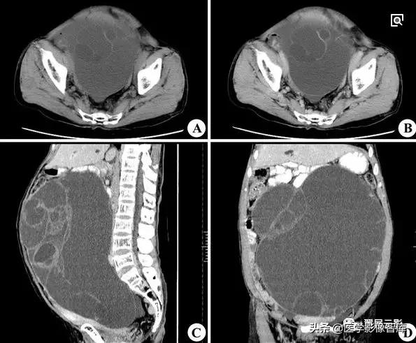 18种泌尿生殖系统常见疾病MR诊断总结