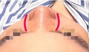 鼻骨太宽应该如何改善？