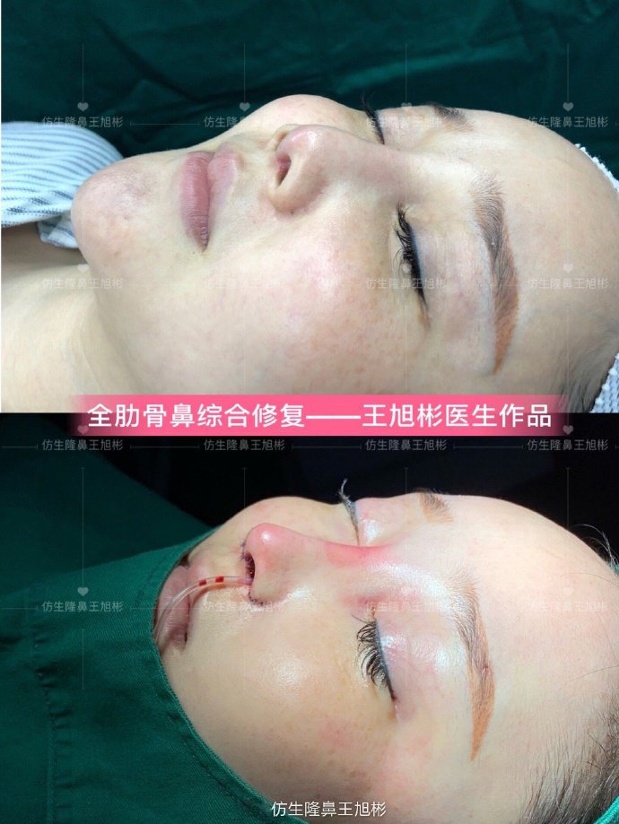 骨粉注射隆鼻皮肤变薄怎么办,线雕隆鼻会引起鼻挛缩吗