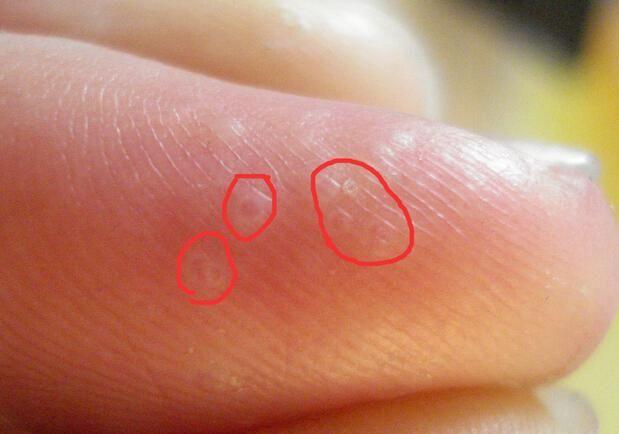 一到春夏手脚就有水泡怎么搞,一到夏天手脚上就起小水泡特别痒