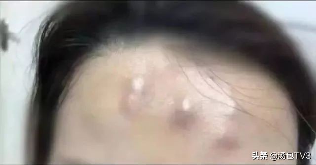 女子打瘦脸针,女子打瘦脸针导致皮肤溃烂