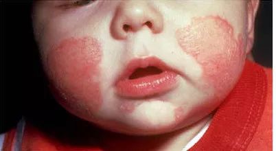 孩子湿疹老不好,孩子长期湿疹的最佳治疗方法