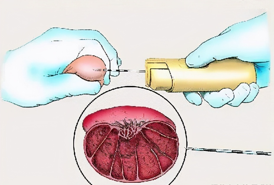 男性身体里那些“装死”的精子