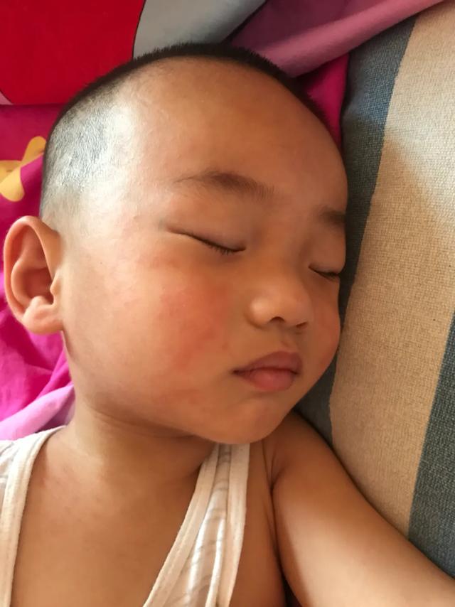 幼儿急疹2岁半宝宝,幼儿急疹第二次