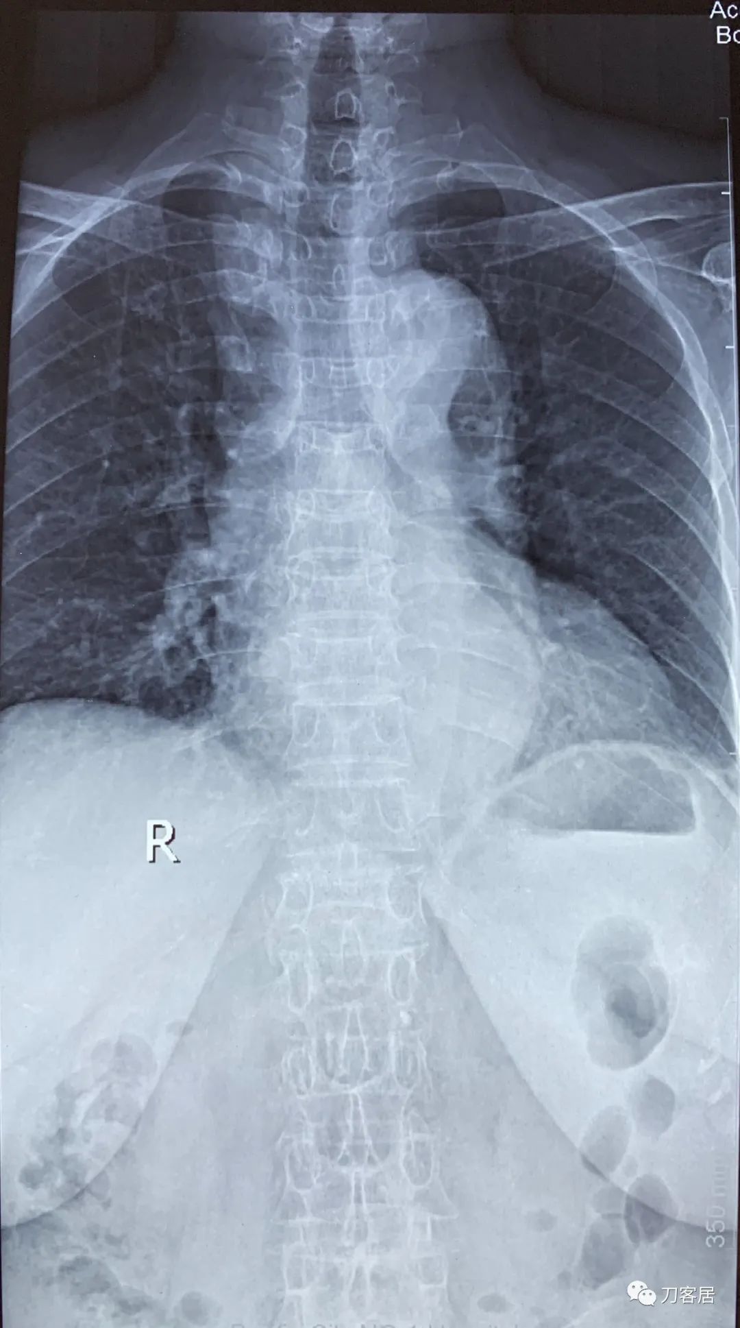 脊柱骨质疏松性压缩性骨折,老年骨质疏松压缩性骨折诊治