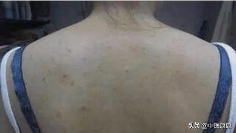 小米粒痘痘怎么快速消除,小米粒痘痘怎么去掉