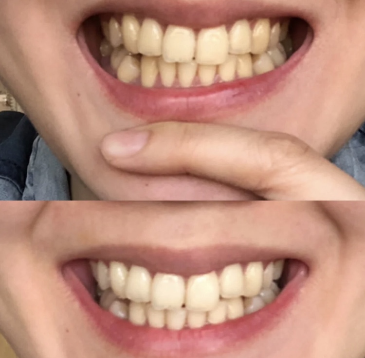 张俪晒出“国宝级”牙膏，用后牙黄牙渍消失了，网友：又要涨价了