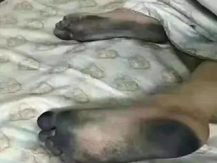 脚被真菌感染水疱型足癣多久才好,真菌足癣可以彻底解决吗