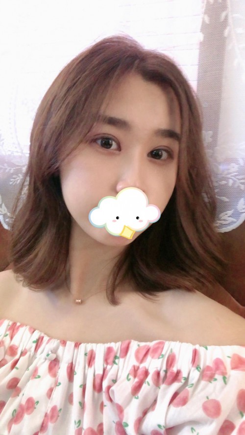 修志夫做双眼皮效果怎么样,修志夫双眼皮修复