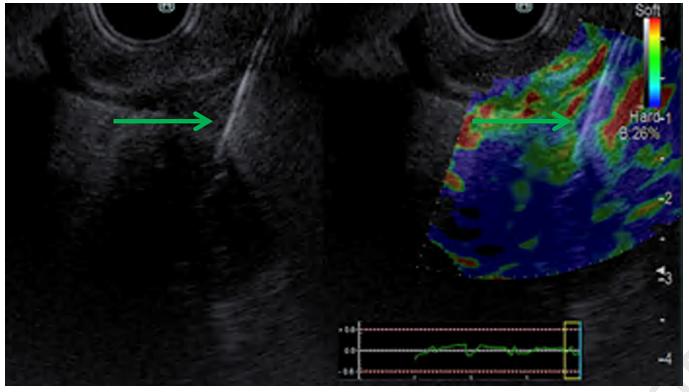 高能超声在晚期胰腺癌中的应用,内镜光动力治疗