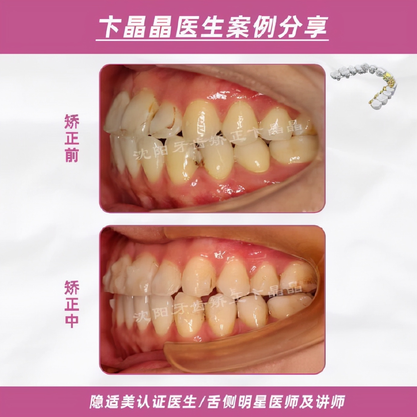 隐适美牙套矫正过程,隐适美个别牙反颌矫正真实案例