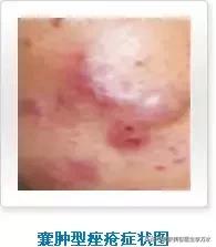 痘痘十大真相,痘痘大全图解