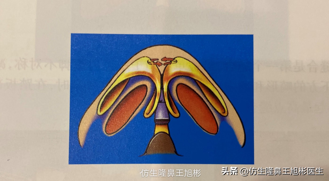 鼻尖整形最简单方法,鼻尖整形的方法图解