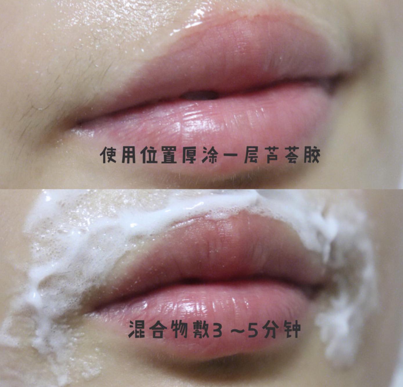 怎么去除唇周黑胡子,长小胡子怎么去除男