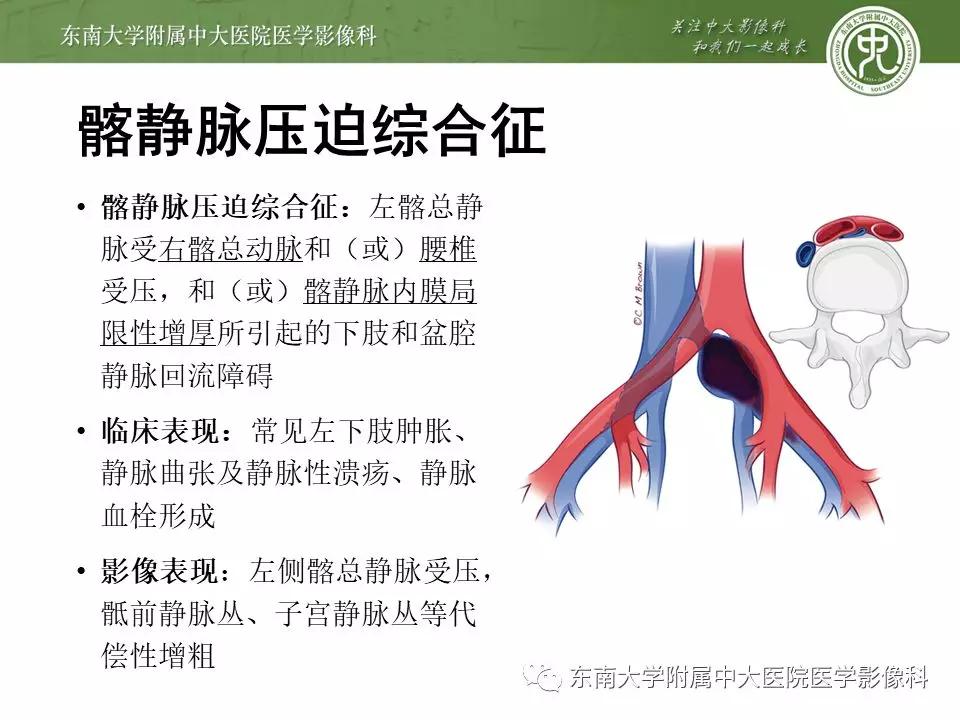 肠系膜上动脉压迫综合征挂什么科,肠系膜上动脉压迫综合征手术费用