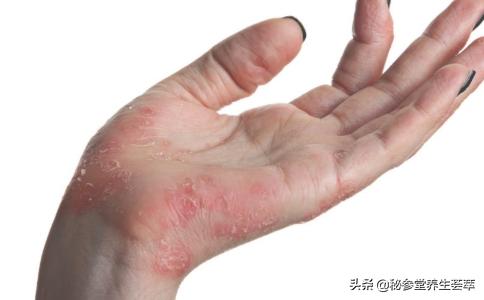 女人产后为什么会皮肤瘙痒,产后十天下体瘙痒怎么回事