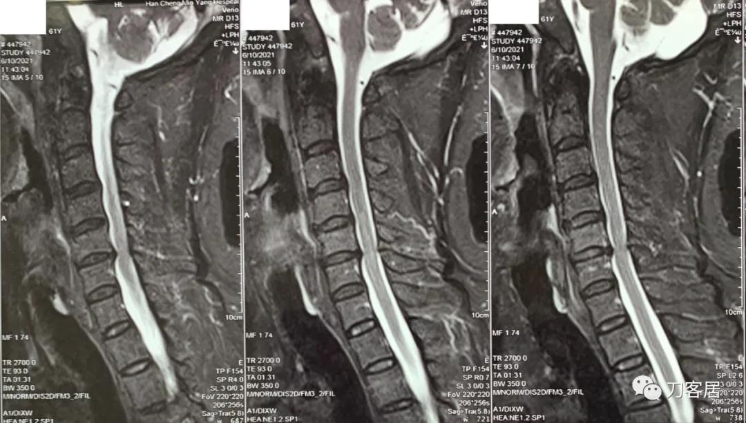 病例左侧躯体麻木,右侧肢体麻木典型病例
