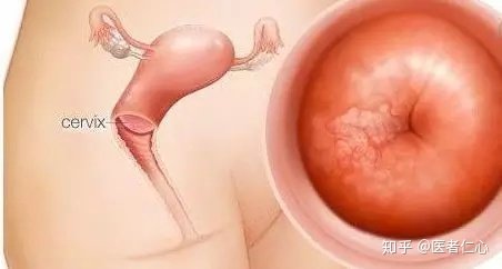 宫颈尖锐性湿疣肉眼可见吗,女性宫颈尖锐性湿疣自己能痊愈吗
