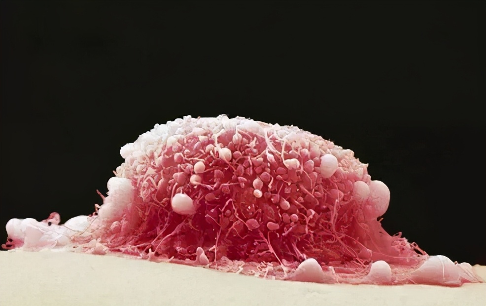 hpv和tct检查哪个更好筛查宫颈癌,宫颈癌筛查tct和hpv能一起做吗