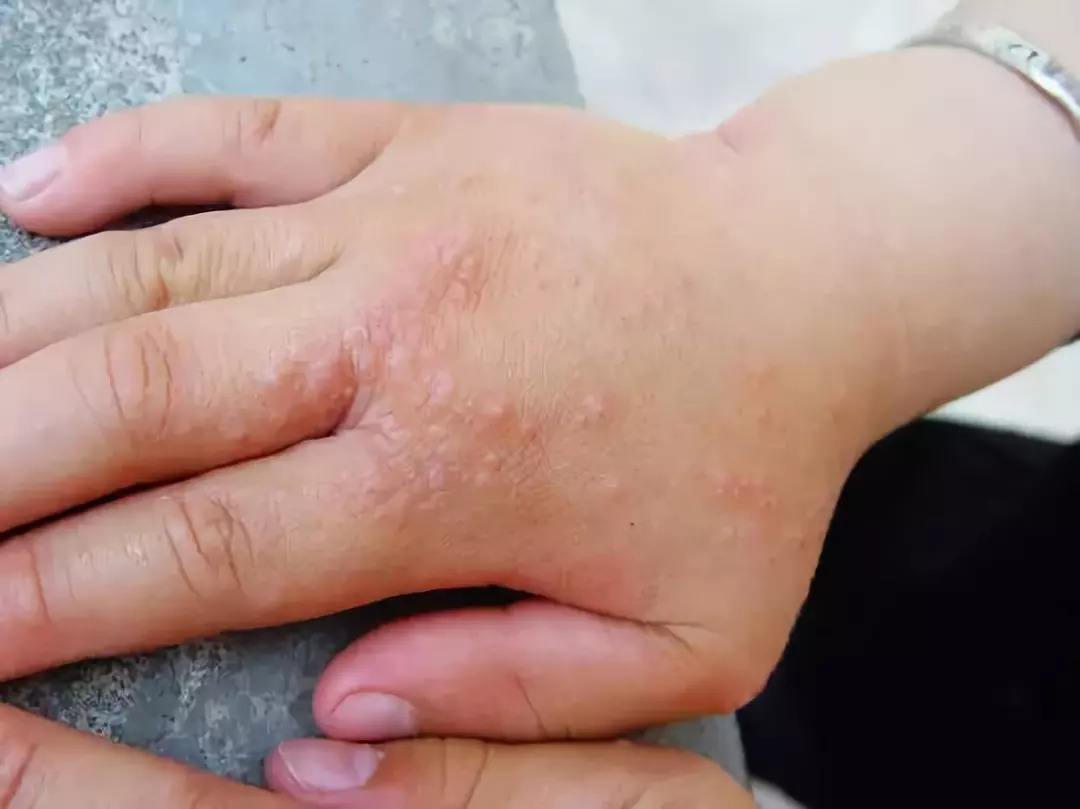 孩子手老是反复脱皮,小孩老是手脱皮什么引起的