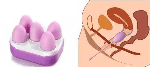 产后盆底肌修复正规医院要多少钱,产后没有漏尿需要做盆底肌修复吗