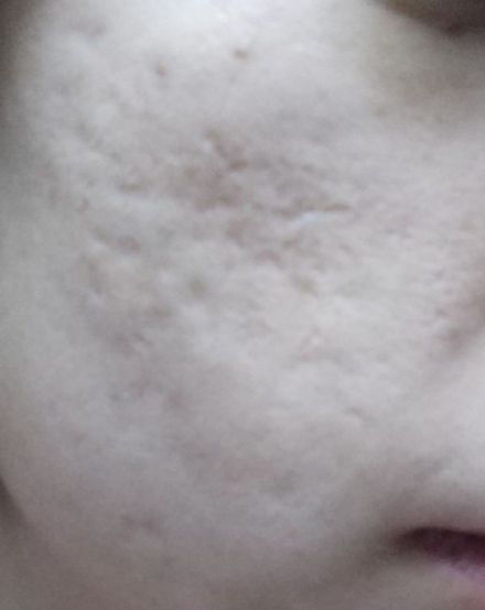 点阵激光能把伤疤完全修复吗,激光点阵可以修复到多少程度