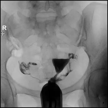 特色诊疗：无痛动态子宫输卵管造影