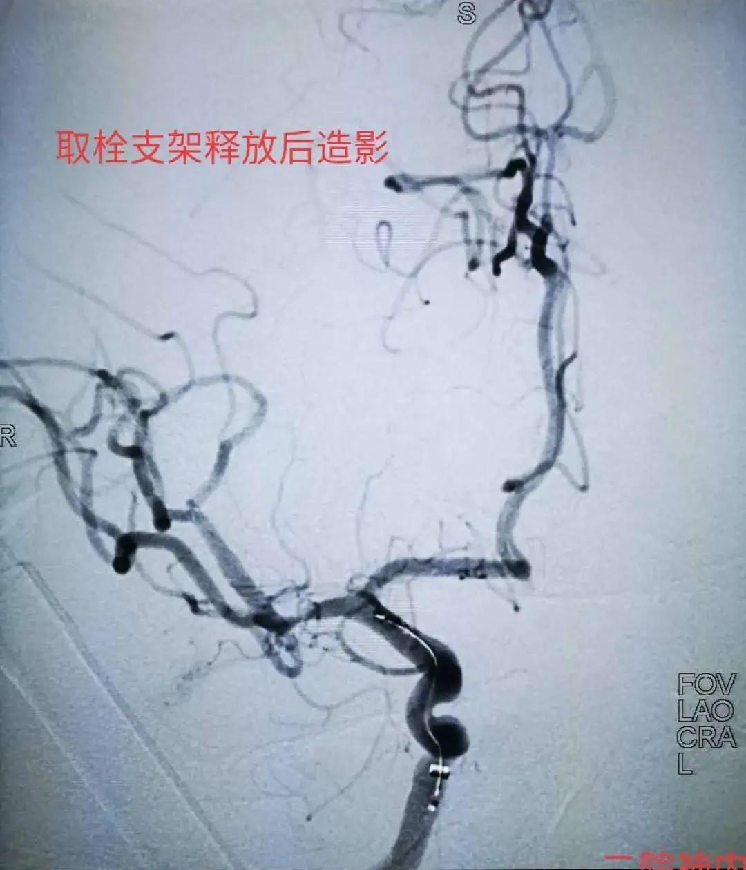 经皮颅内动脉取栓术全过程,为患者打开生命希望之门