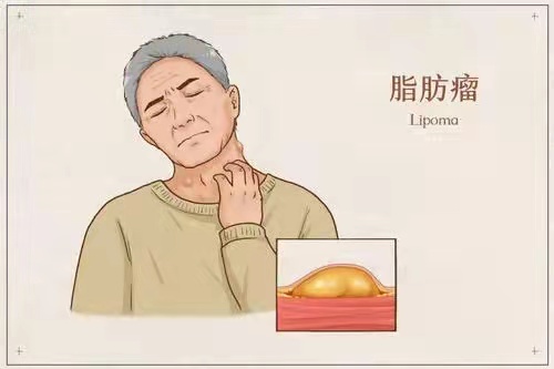 皮肤长肉疙瘩、脂肪瘤？4味中药，一消一补，标本兼顾