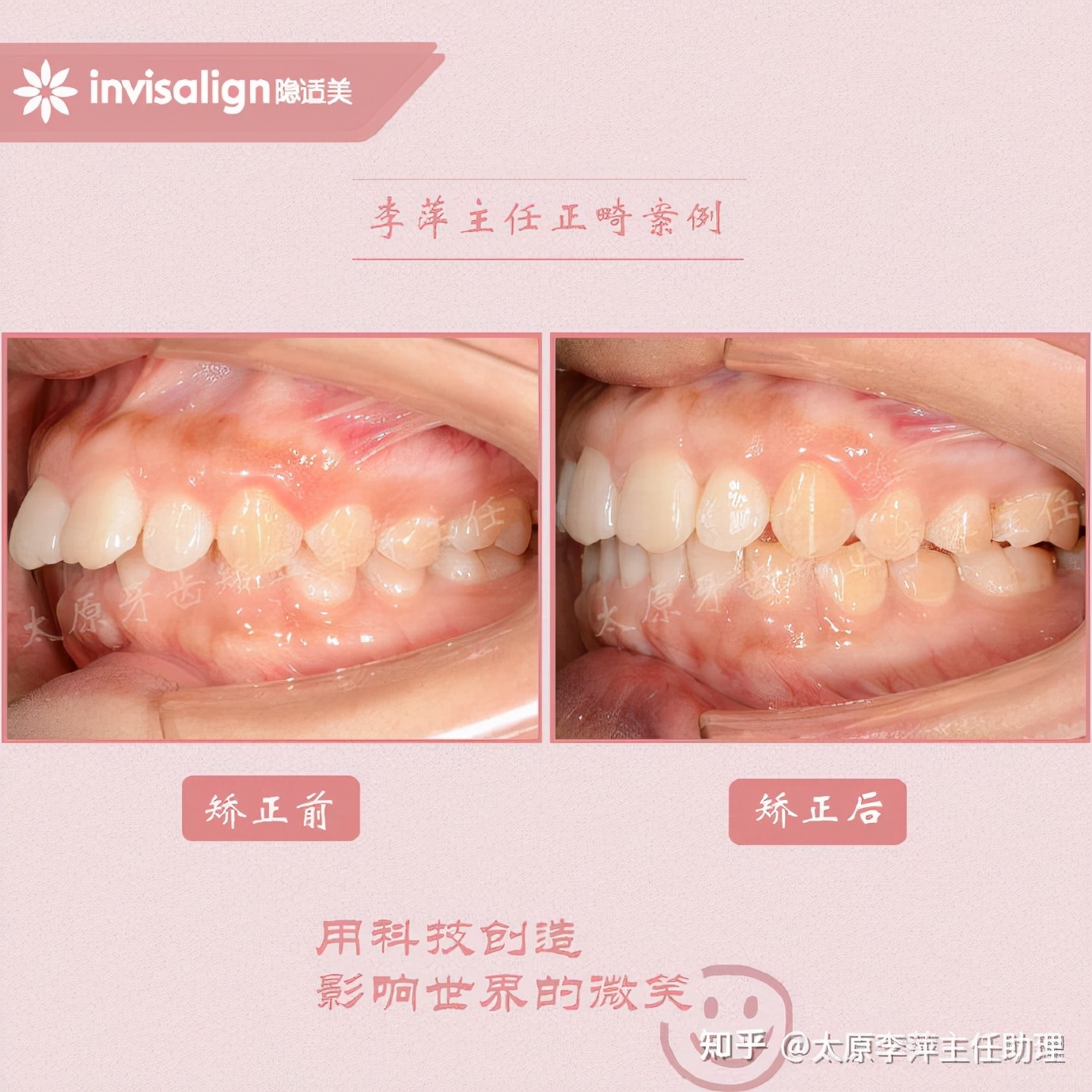 太原牙齿矫正靠谱吗,太原成人隐形牙套牙齿不齐